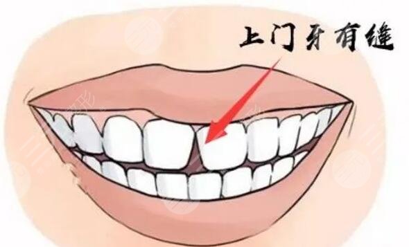 门牙有缝怎么缓解合理?