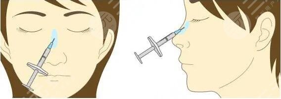 注射隆鼻需要注意什么问题?