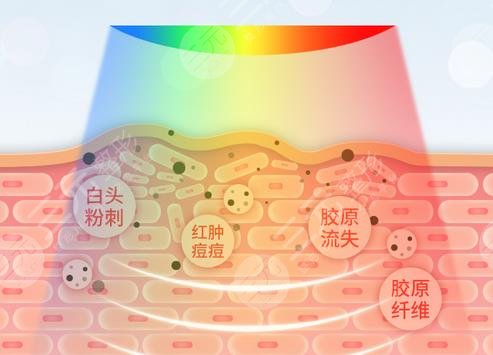 红光缓解痤疮能不能?每天都照