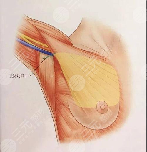 假体隆胸术有哪些特点?