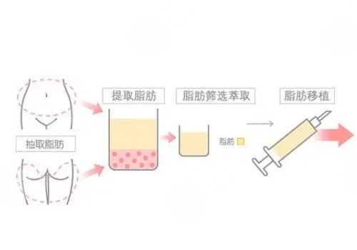 面部自体脂肪填充可以维持多久?