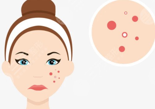 脸上痘坑可以修复吗?