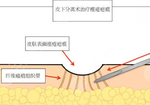 脸上痘坑可以修复吗?