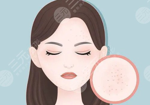 脸上痘坑可以修复吗?