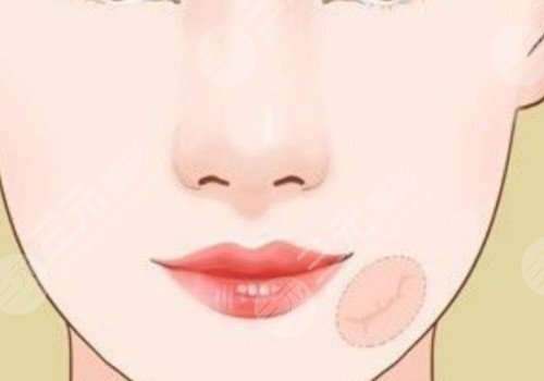 如何祛除脸上的疤痕?