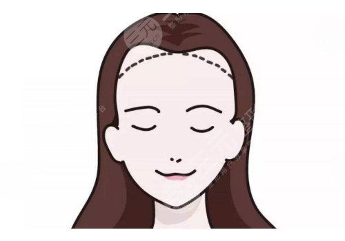 发际线高怎么挽救?