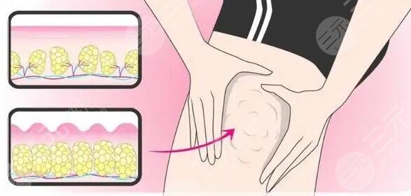 抽脂减肥怎么做?