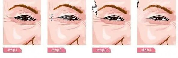 去除鱼尾纹有副作用吗?