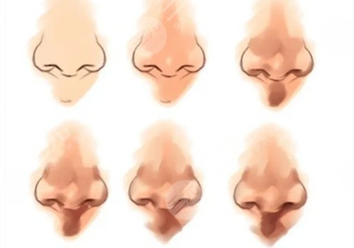 鼻头鼻翼缩小多少钱?