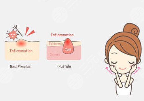 嘴角长痘痘是什么原因导致的？