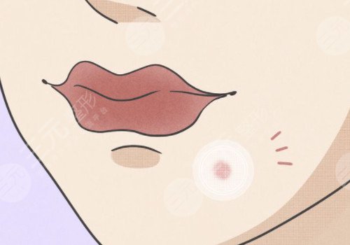 嘴角长痘痘是什么原因导致的？