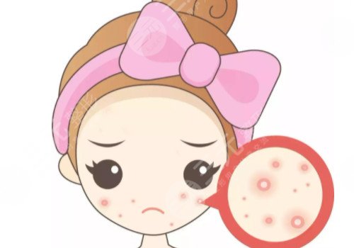 嘴角长痘痘是什么原因导致的？