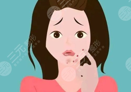 嘴角长痘痘是什么原因导致的？