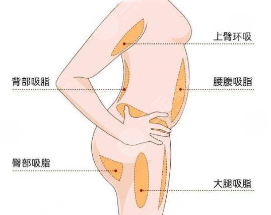五度吸脂后需要注意什么？