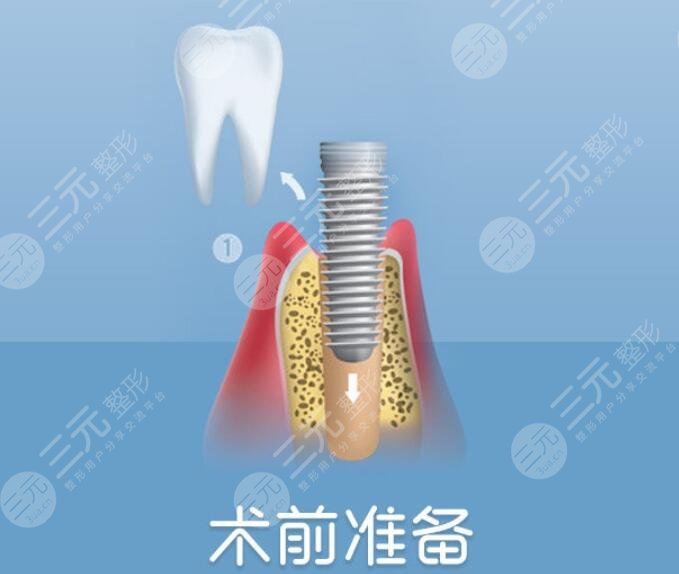 德国种植牙之后需要注意什么?