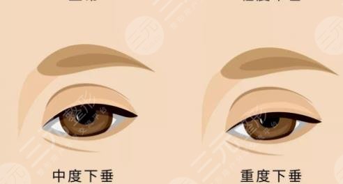 上睑下垂术
