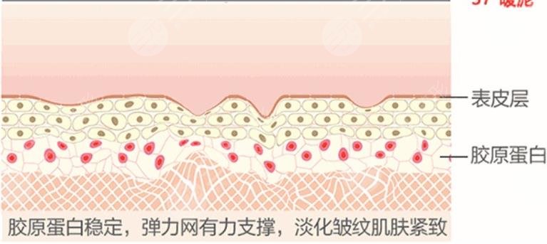热玛吉