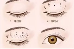 不开刀的双眼皮什么原理？手术知识超全科普！医美小白必看~