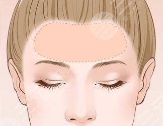 面部自体脂肪填充可以维持多久?