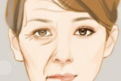 玻尿酸除皱需要多少钱?注射除皱原理是什么?自体填充果如何? 玻尿酸除皱需要多少钱?注射除皱原理是什么?自体填充果如何?