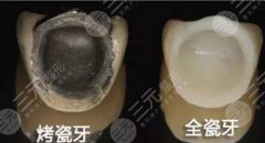 烤瓷牙材料有哪些？做烤瓷牙的价格是多少？价格表参考