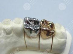 钛合金义齿价格的影响因素有这三点！钛合金义齿有什么优点？