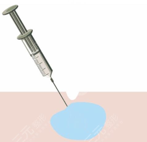 玻尿酸注意事项