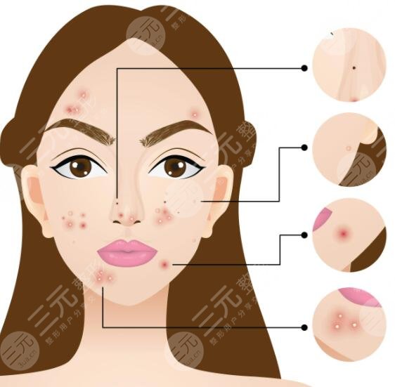 激光祛痘后注意事项是什么？