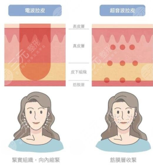 热玛吉抗衰果好吗?