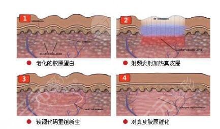 热玛吉抗衰老一次能保持多久?