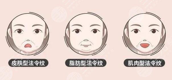 法令纹手术价钱一般多少钱?