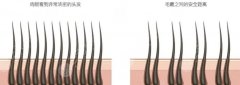 额头头发稀少怎么办？毛发移植技术可靠吗？头发稀少的原因有哪些？