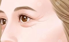 怎么去鱼尾纹？鱼尾纹形成的原因有哪些？如何预防呢？