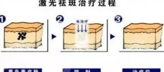 激光美容祛斑价格是多少？激光祛斑原理get！价格高低和哪些因素有关？
