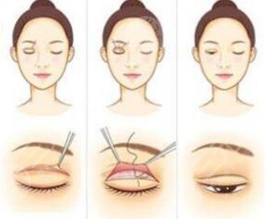 双眼皮修复