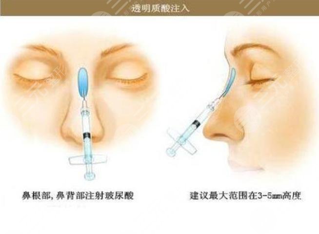 玻尿酸隆鼻