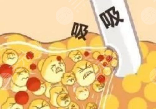 影响胳膊吸脂价格的因素?: