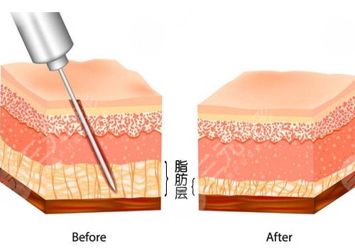 影响胳膊吸脂价格的因素?: