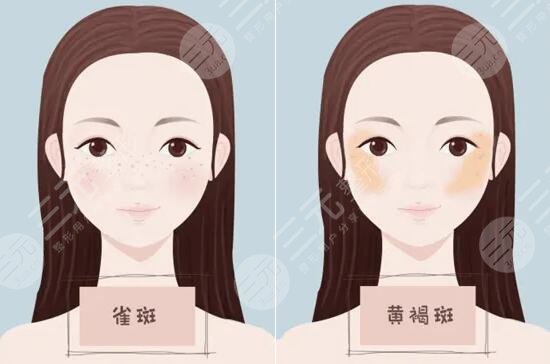 上海缓解雀斑多少钱一次?