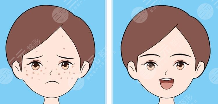 上海缓解雀斑多少钱一次?