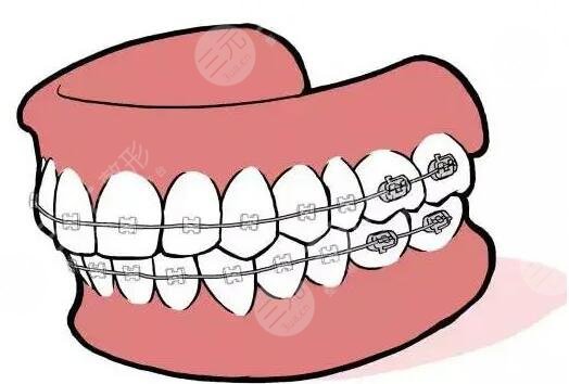 牙齿矫正注意事项