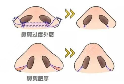 鼻头缩小的案例介绍
