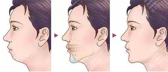 隆下巴假体恢复过程图