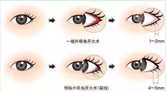 开眼角的恢复期是多久？禁忌人群和注意事项盘点！还有真人案例