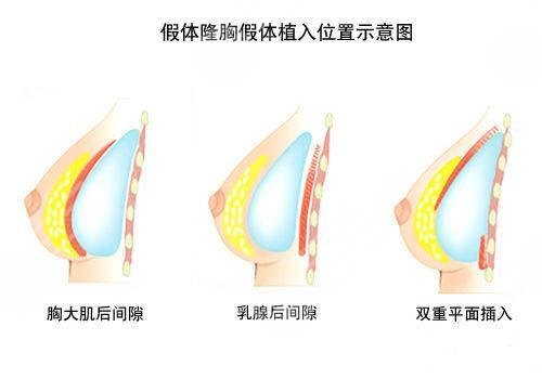 水滴型胸部好不好