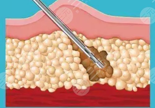成都高新怡脂医疗美容怎么样?