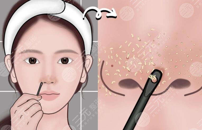 苏打水去黑头的注意事项