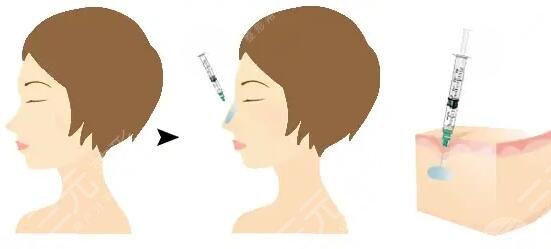 玻尿酸隆鼻手术的案例