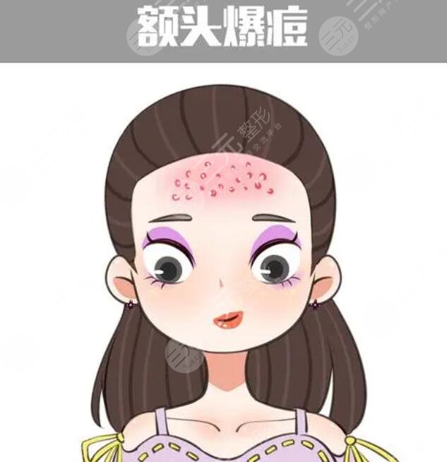 　　额头上长痘痘的原因是什么呢?长痘痘是很多朋友的心头大患，因为在进入青春期之后，很多朋友脸上都会或多或少的长出痘痘，痘痘又红又肿，有的时候还有很多分泌物，一碰就很疼，这给大家带来了很多的烦恼。而有一部分朋友即便是走出了青春期，脸上仍旧有很多的痘痘存在。尤其是额头上的痘痘特别的严重。实际上不同的部位痘痘生长都是有原因的，下面就针对额头上的痘痘，我们进行深入的分析。  　　1、额头上长痘痘的原因是什么?  　　痘痘又被大家称作为痤疮或者青春痘。一般在额头上，脸上，胸部背部长得比较多。因为这些部位皮肤角质层比较薄，而且油脂分泌旺盛，给痘痘的生长提供了很好的条件。痘痘的生长是由于皮肤里面生产了大量的油脂，将毛孔堵塞。尤其是油脂栓塞了毛囊口加上周围致痘细菌的影响，就形成了丘疹痘痘。这些痘痘一般呈现出红色，用手轻轻挤压就会挤出黑色的乳状或者是乳白色的脂栓。  　　因为痘痘生长的位置比较靠近皮肤较深的部位，所以这些痘痘与周围组织有紧密的联系。如果痘痘变得过于的大或者过于深，很容易引起炎症。有时痘痘生长以后不容易干瘪脱落，有形成暗疮和痘坑痘印的风险。青春期生长痘痘的几率比较大。因为青春期的时候，人体内分泌容易紊乱，雌性激素和雄性激素分泌的情况会发生变化，所以就很容易生长痘痘。  　　2、去除痘痘的方法  　　去除痘痘要内外兼治，首先要调节饮食。少吃辛辣的食物，不吃油腻的食物，对于膨化食品也要少吃。这些食物有很大的刺激性，对于身体来讲容易产生消化负担，而且容易堆积垃圾，产生毒素。多吃维生素含量高的食物与水果，调节脾胃功能，促进肠胃蠕动，可以加快毒素的排出。  　　如果身体里有内分泌紊乱的现象，可以吃药物调节。目前比较多的是四环素多，西环素米诺环素等这些药物。可以使皮肤的脂肪酸浓度下降，抑制丙酸痤疮菌的活性使青春痘生长丧失温床。适当的运动。运动的时候身体产生大量的热量。毛孔也会打开释放热能。随着大量汗液的流出，也会有很多垃圾和油脂被排出体外给皮肤做深层洁面。  　　痘痘生长的过程中，不要用手去挤压或者触碰，可以涂抹消肿药膏。芦荟胶、祛痘膏都可以涂抹。避免因为错误的方法把痘痘变得红肿，干痒产生炎症，留下痘坑痘印儿。当痘痘生长过于密集的时候，可以采用镭射激光，光子嫩肤，二氧化碳，点阵激光等方式来缓解痘痘。  　　3、额头上长痘痘的案例介绍  　　青春期之后我的额头开始长痘痘，有很多人告诉我，青春期过后痘痘就会消除，可是我千辛万苦等到青春期结束直到二十几岁，额头上的痘痘一直没有停止过生长，后来去看医生，医生说额头上的痘痘映射了新陈代谢不好的问题。建议我可以尝试一下内服药物调理内分泌系统。于是我就在医生的建议下，吃了大概三个月的中药。  　　中药的主要作用就是舒筋活络，加速代谢，排解垃圾。自从吃了中药以后，我感觉自己整个身体经营了很多，很多之前会有习惯性的便秘，但是慢慢的身体的消化系统舒适了，不再出现胃酸反胃便秘等这些问题。大概在吃药后的一个月再次来月经的时候，脸上并没有长出原来那么多痘痘，只是少许的几颗，这让我看到了曙光，于是连续吃了三个月，现在基本调理好了。