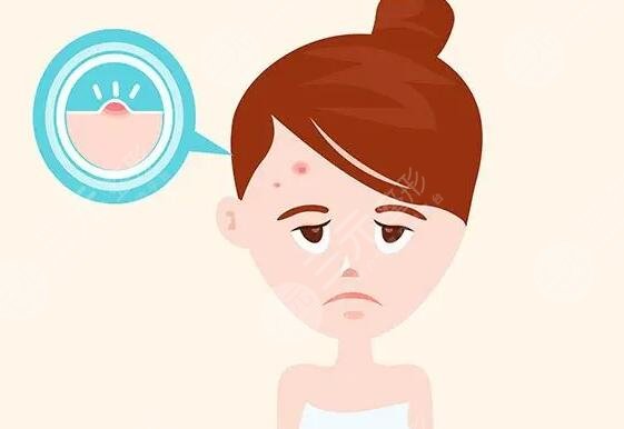 额头上长痘痘的原因是什么?